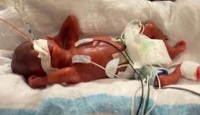 21 haftalık doğdu, en erken doğan bebek oldu