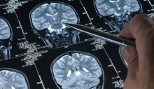 Yapay zeka Alzheimer’ı yüzde 90 oranında tespit edebildi