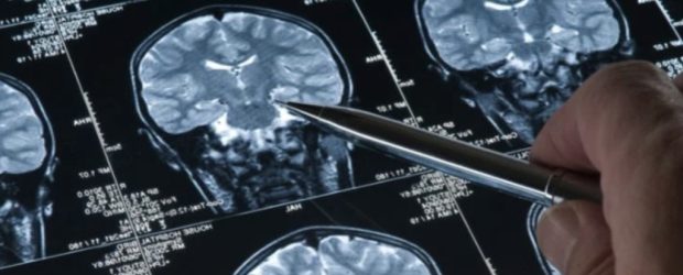 Yapay zeka Alzheimer’ı yüzde 90 oranında tespit edebildi