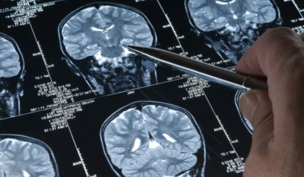 Yapay zeka Alzheimer’ı yüzde 90 oranında tespit edebildi