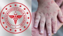 Türkiye’de kızamık alarmı: 81 ile yazı gönderildi!