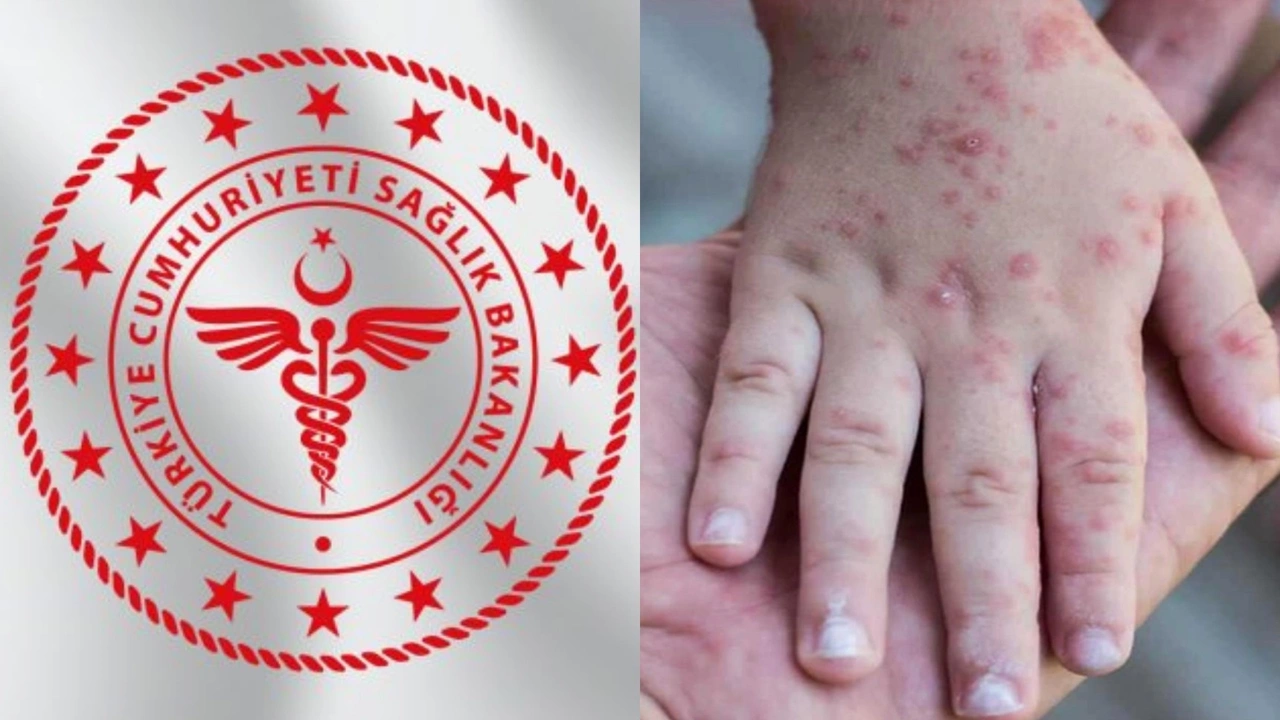 Türkiye’de kızamık alarmı: 81 ile yazı gönderildi!